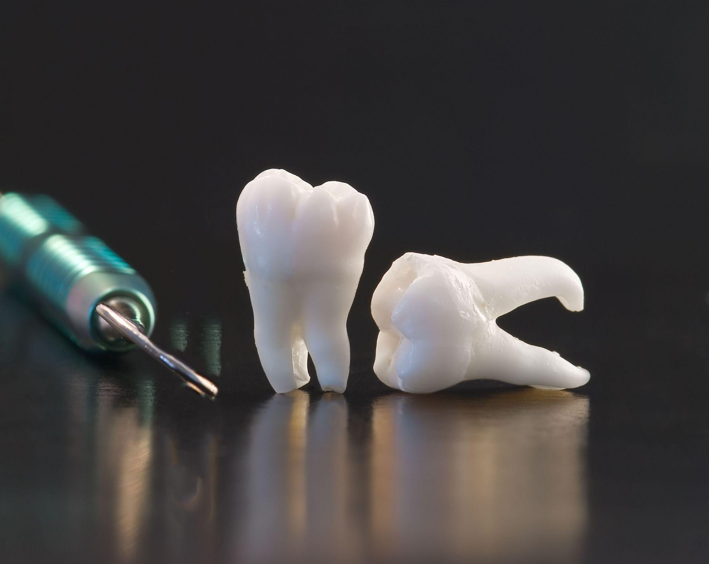 Ilustrativni prikaz dentalnih nadoknada.
